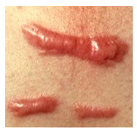 Keloid Scarring Southampton