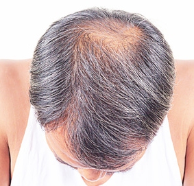 balding treatments Southampton