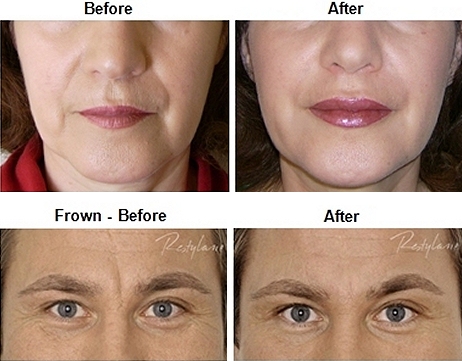 dermal fillers southampton