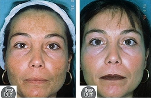 chemical skin peels southampton