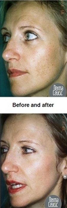 chemical skin peels southampton