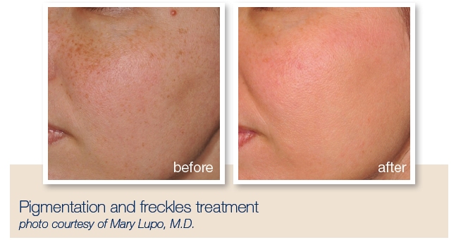 Treatment for pigmentation, age spots, sun damage, broken capillaries Southampton