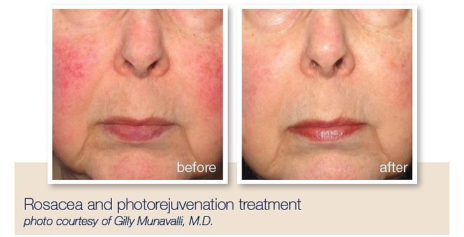 Treatment for pigmentation, age spots, sun damage, broken capillaries Southampton