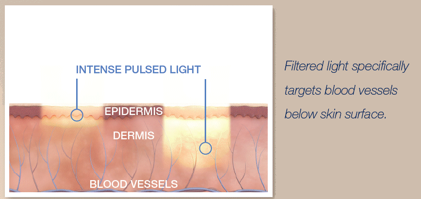 Treatment for pigmentation, age spots, sun damage, broken capillaries Southampton