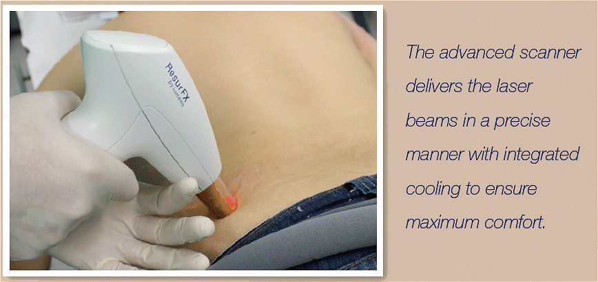 stretch mark treatment southampton