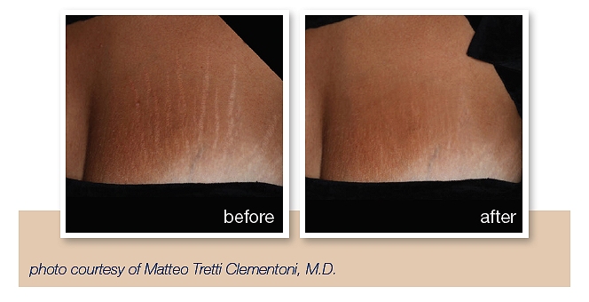 get rid of stretch marks southampton