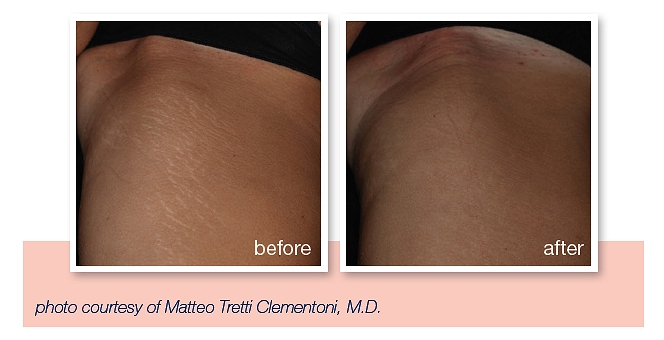 get rid of stretch marks southampton