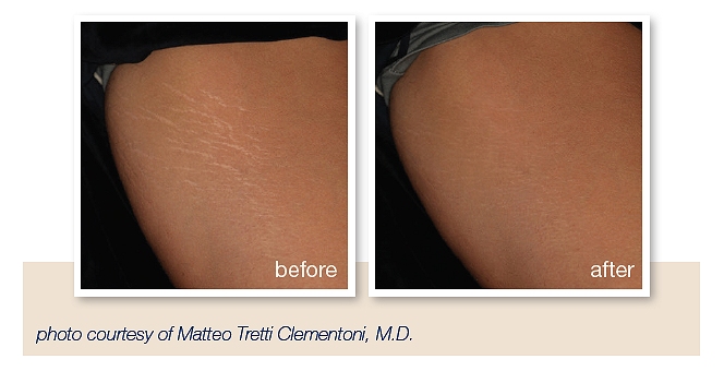 get rid of stretch marks southampton