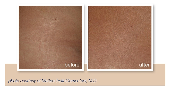 get rid of stretch marks southampton