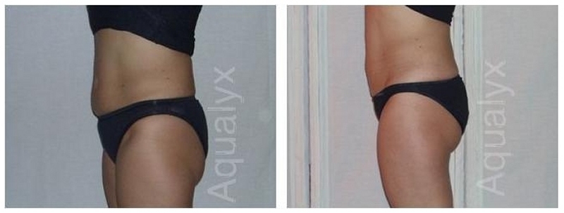 Aqualyx Fat Removal southampton