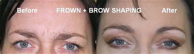 brow lift southampton