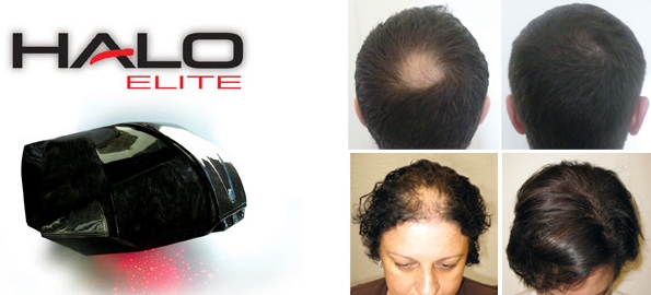 hair loss treatments southampton