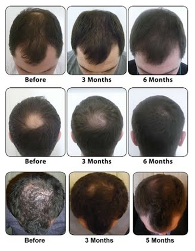 hair loss treatments southampton
