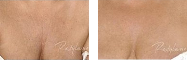 decollete treatments southampton