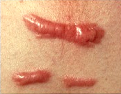 Keloid Scar Removal Southampton