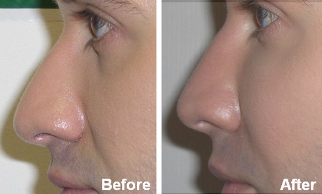 nose reshaping southampton