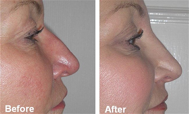 nose reshaping southampton