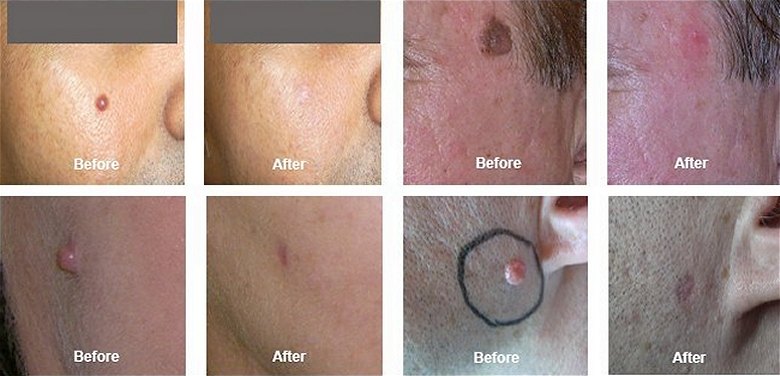 Mole and Skin Tag Removal southampton